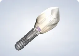 home  dental implants